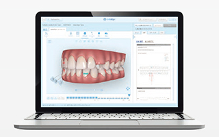 インビザライン専用3Dシミュレーション